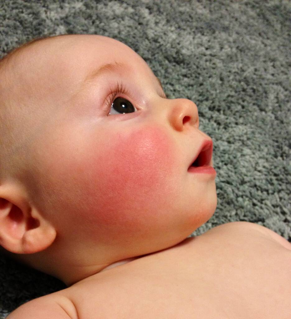Почему у новорожденного может быть. Гнейс атопический дерматит. Красные щеки у грудничка.