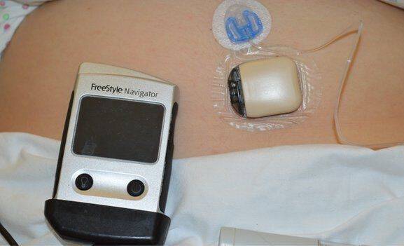 Ο πρώτος φυσιολογικός τοκετός από διαβητική γυναίκα χάρη στο «τεχνητό πάγκρεας»