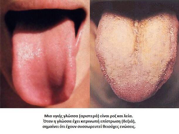 Κακοσμία στόματος: Μήπως φταίει η… γλώσσα σας; (φωτογραφίες)