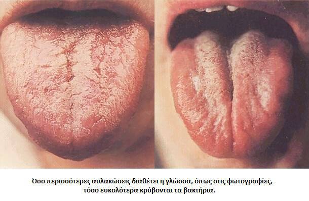 Κακοσμία στόματος: Μήπως φταίει η… γλώσσα σας; (φωτογραφίες)