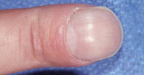 Πέντε ύπουλα προβλήματα υγείας που φαίνονται στα νύχια (εικόνες)