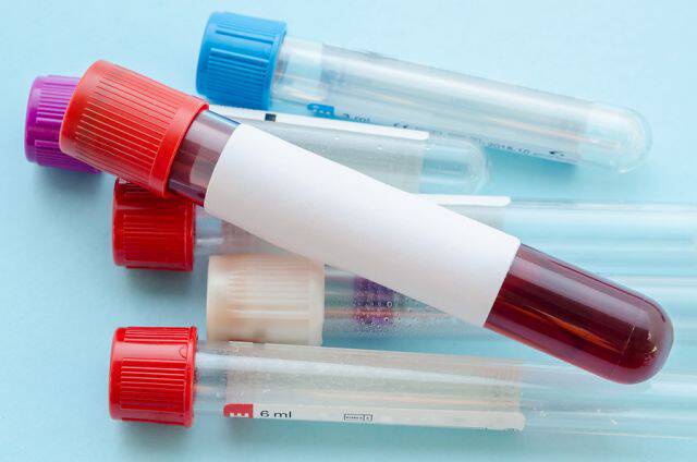 Οι αιματολογικές εξετάσεις που πρέπει να κάνουν όσοι είναι γύρω στα 50