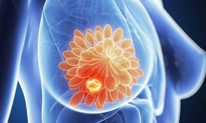 Καρκίνος μαστού : Τα νέα «όπλα» στην πρόγνωση και τη θεραπεία του