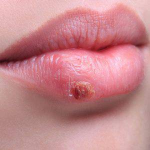 bigstock-beautiful-lips-virus-infected-79990079