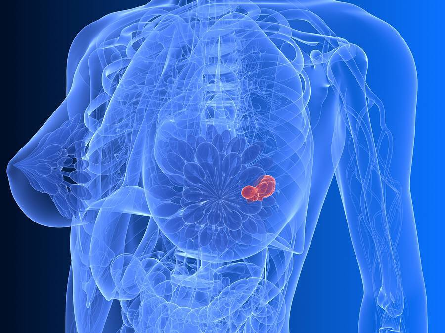 Καρκίνος μαστού: 4 επιλογές των γυναικών που αναδεικνύονται σε παράγοντες κινδύνου