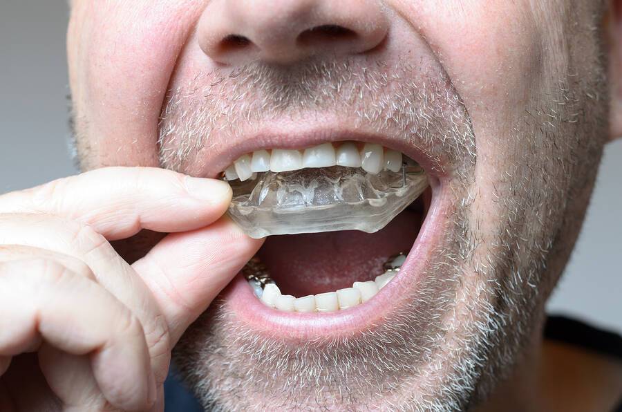 Προστατευτικοί νάρθηκες δοντιών: Δείτε πότε είναι απαραίτητοι