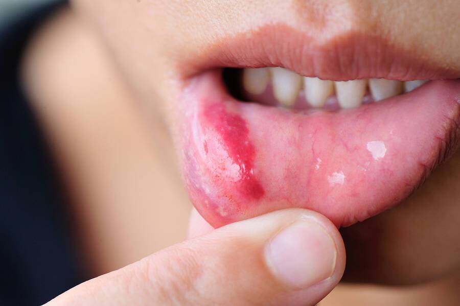 Άφθες στο στόμα: Ποιες παθήσεις μπορεί να κρύβουν