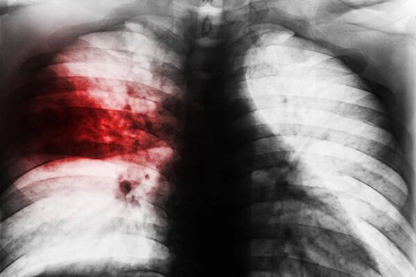 Διπλή πνευμονία: Τι είναι και με ποια συμπτώματα εκδηλώνεται