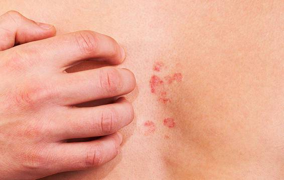 Τροφική αλλεργία: Πέντε συμπτώματα που δεν πρέπει να αγνοήσετε