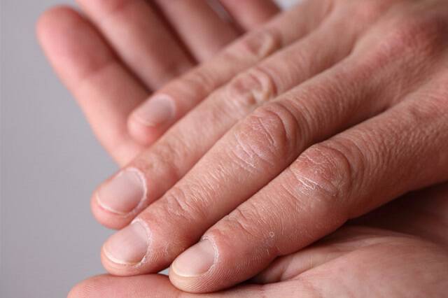 Σημάδια στο δέρμα και στα νύχια που δείχνουν καρκίνο, διαβήτη, έρπη