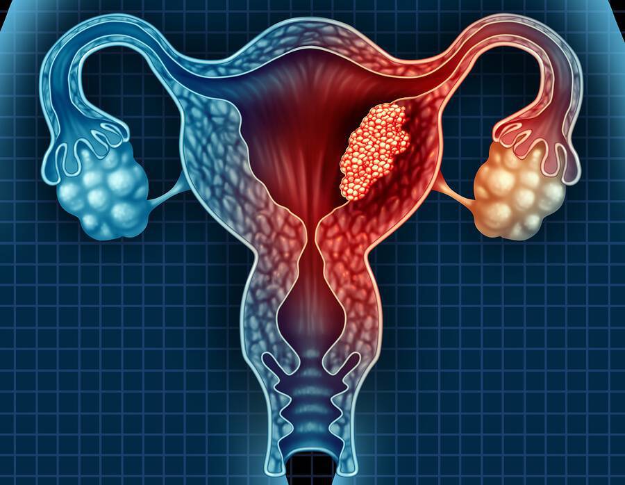 Καρκίνος του τραχήλου της μήτρας: Τα 7 συμπτώματα του πιο ύπουλου γυναικολογικού καρκίνου