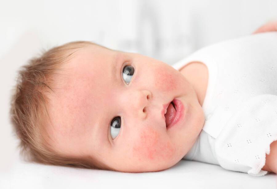 bigstock Adorable baby with skin allerg 208561669