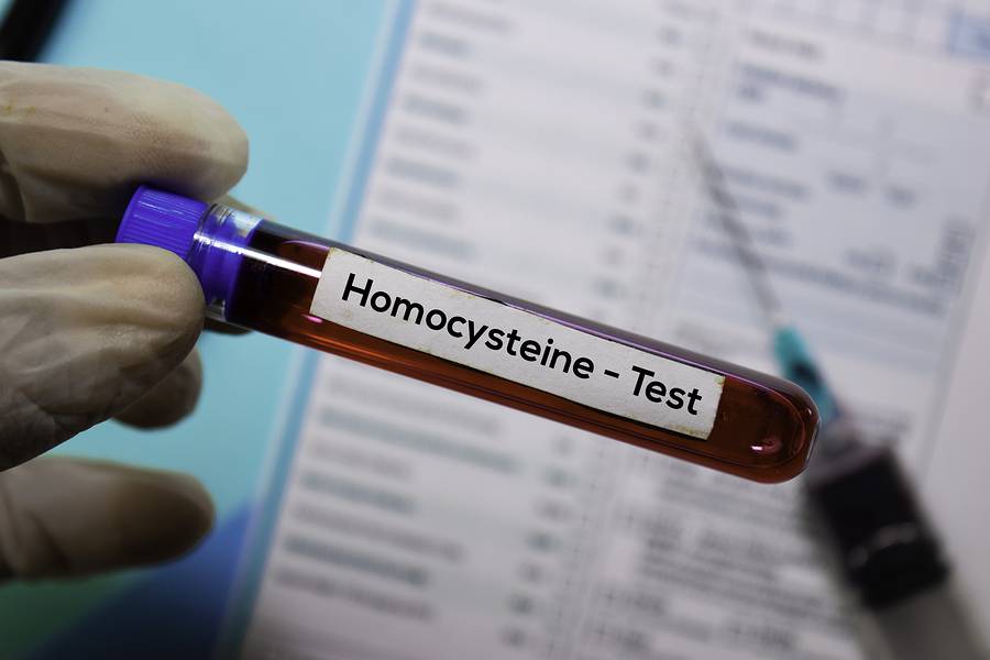 bigstock Homocysteine Test With Blood 319871437