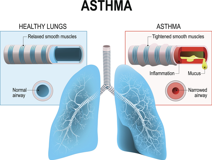 Άσθμα: 5 ενέργειες που μπορείτε να κάνετε για να διατηρήσετε την υγεία των πνευμόνων