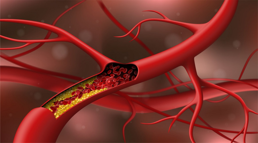 Artery Blocked By Cholesterol. Red Blood Cells In An Artery Blocked By Cholesterol Vector Illustrati