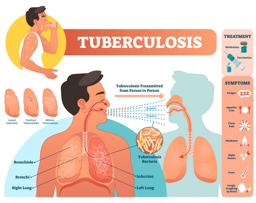 Tuberculosis-fymatiosh